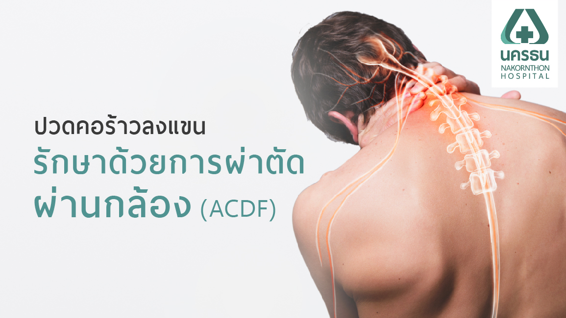 ปวดคอร้าวลงแขน รักษาด้วยผ่าตัดหมอนรองกระดูกคอทับเส้นประสาทผ่านกล้อง (ACDF)